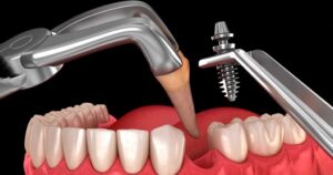 Trồng Răng Implant Tức Thì: Điều Kiện Và Quy Trình Thực Hiện