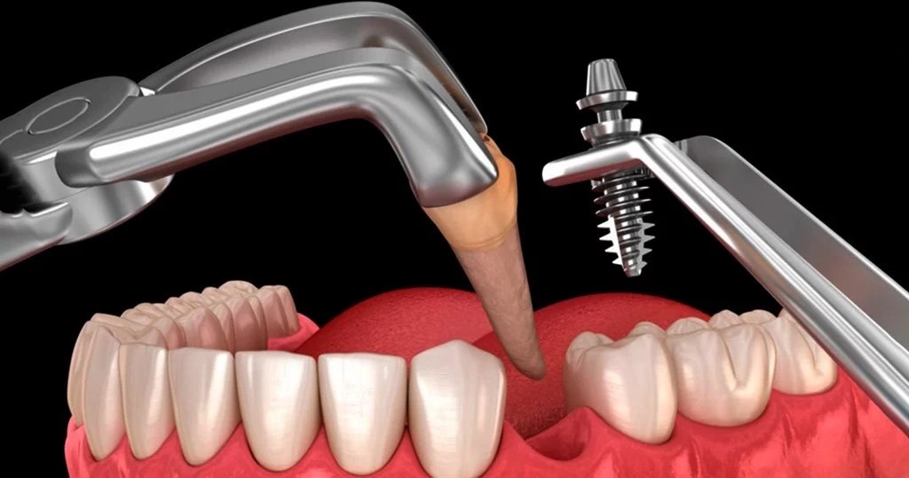Trồng Răng Implant Tức Thì: Điều Kiện Và Quy Trình Thực Hiện - ảnh 1