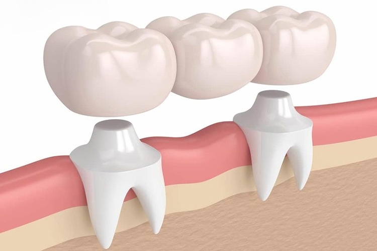 Làm Cầu Răng Số 5 Có Tốt Không? Có Bền Không? Giá Bao Nhiêu? - ảnh 6