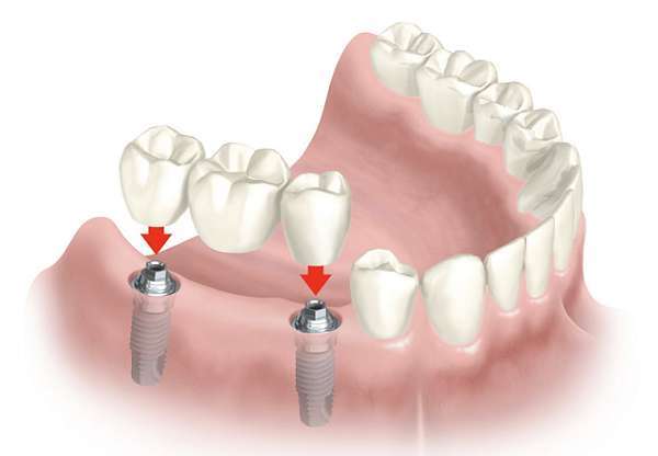 Trồng Răng Implant Loại Nào Rẻ Nhất? - ảnh 12
