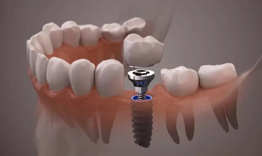Trồng Răng Implant Loại Nào Đắt Nhất Hiện Nay? - ảnh 3