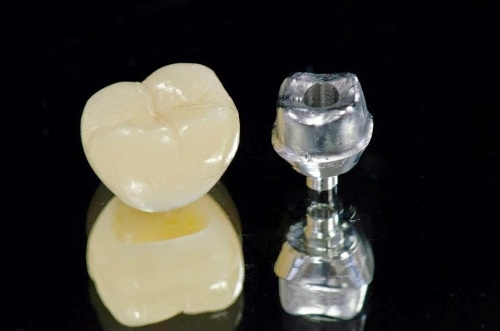 Trồng Răng Implant Giá Bao Nhiêu? - ảnh 7