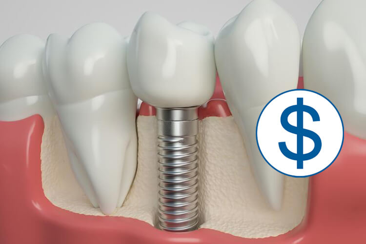 Trồng Răng Implant Giá Bao Nhiêu? - ảnh 6