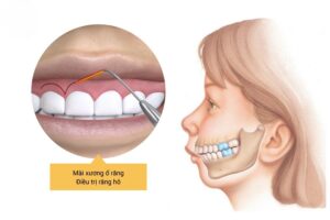 Mài Xương Ổ Răng Có Giảm Hô Không? Giá Bao Nhiêu?