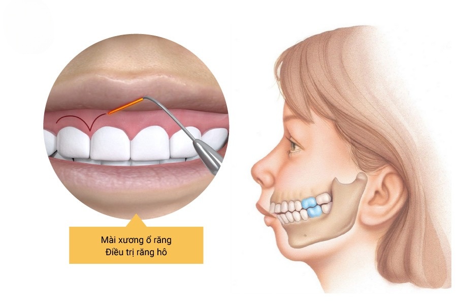 Mài Xương Ổ Răng Có Giảm Hô Không? Giá Bao Nhiêu? - ảnh 1