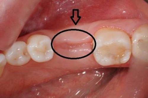 Nhổ Răng Bao Lâu Thì Lành, Có Phải Kiêng Gì Không? - ảnh 4