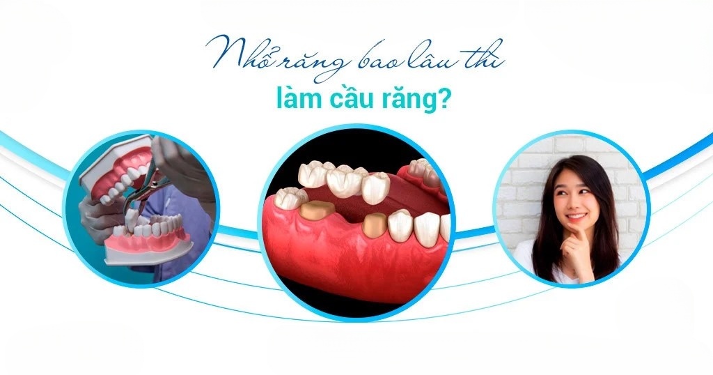 Nhổ Răng Bao Lâu Thì Làm Cầu Răng Sứ? - ảnh 1