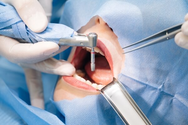 Trồng Răng Implant Giá Bao Nhiêu? - ảnh 5