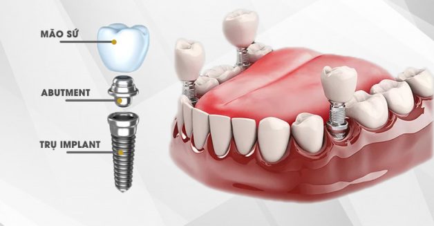 Trồng Răng Implant Loại Nào Rẻ Nhất? - ảnh 2