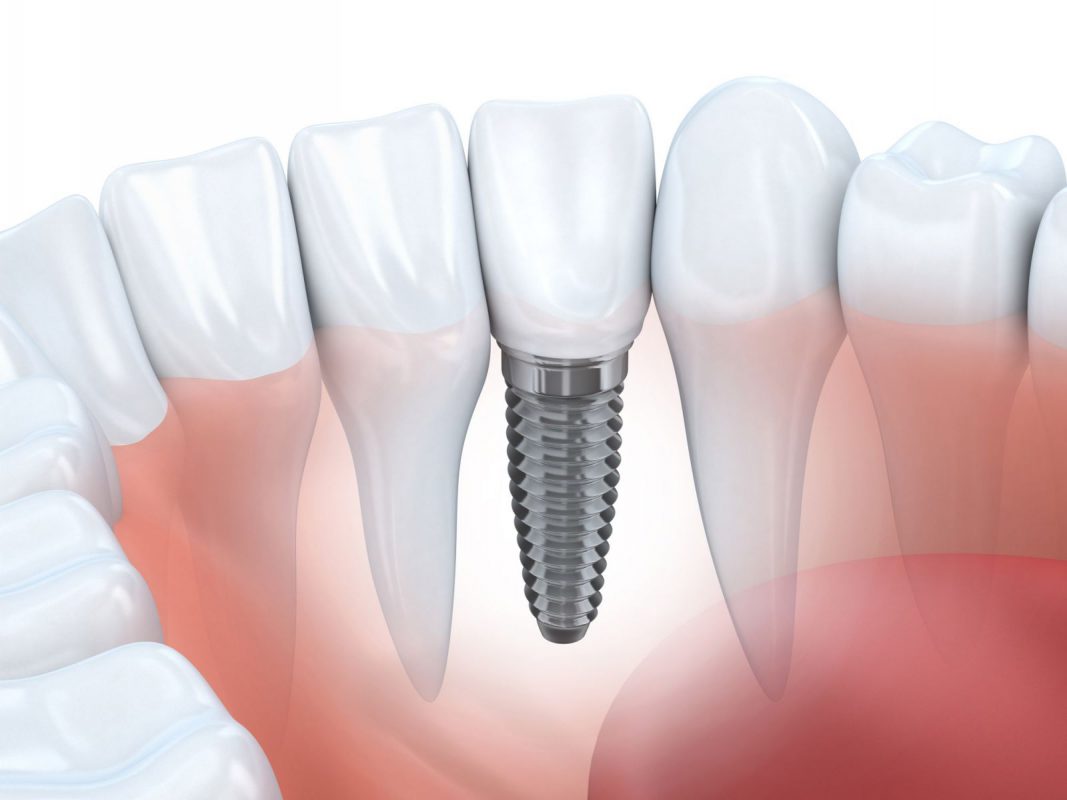 Trồng Răng Implant Giá Bao Nhiêu? - ảnh 2