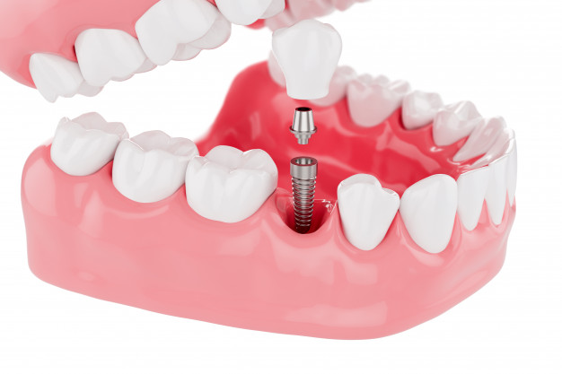 Trồng Răng Implant Loại Nào Bền Nhất? - ảnh 1