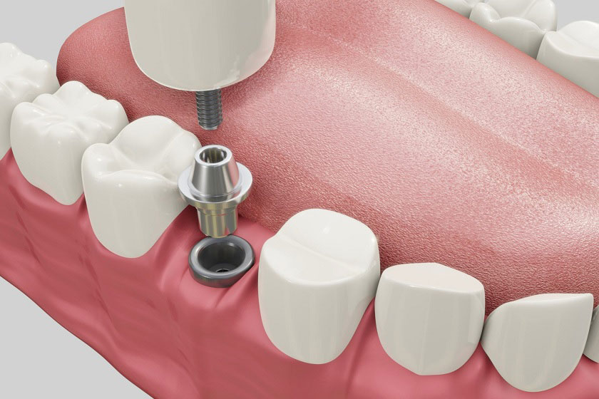 Trồng Răng Implant Loại Nào Đắt Nhất Hiện Nay? - ảnh 1