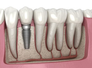 Trồng Răng Implant Loại Nào Rẻ Nhất?
