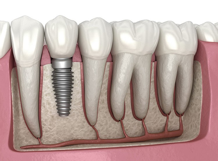 Trồng Răng Implant Loại Nào Rẻ Nhất? - ảnh 1