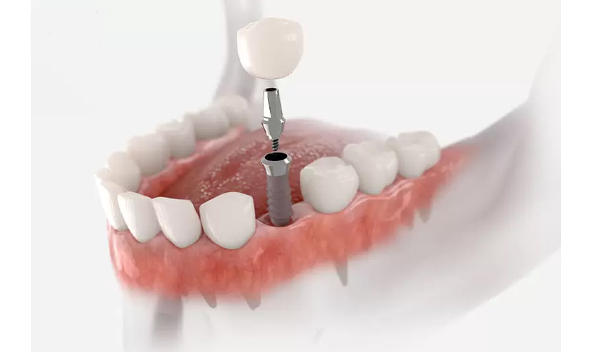 Trồng Răng Implant Loại Nào Rẻ Nhất? - ảnh 7