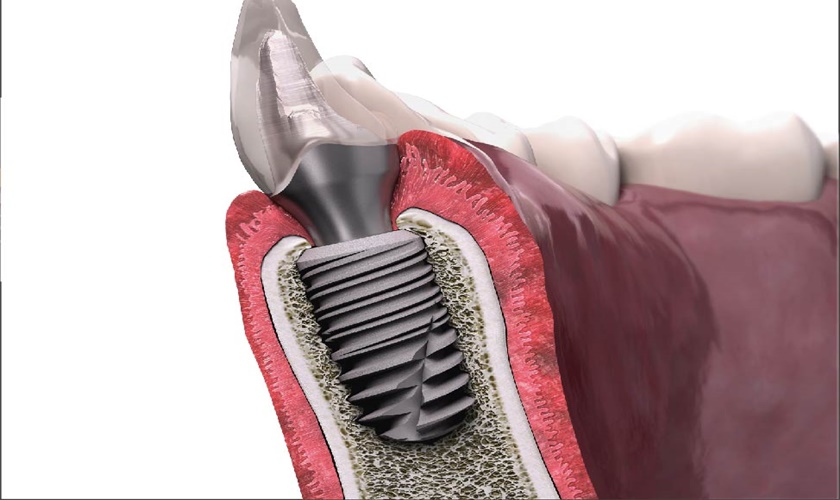Trồng Răng Implant Loại Nào Bền Nhất? - ảnh 6