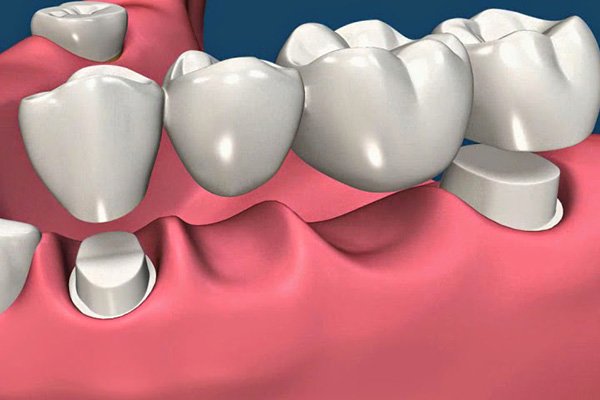So sánh cầu răng sứ và Implant? Nên chọn loại nào tốt?