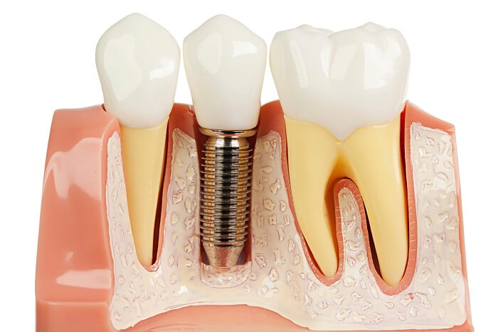 Trồng Răng Implant Loại Nào Rẻ Nhất? - ảnh 5