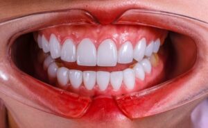 Bao Nhiêu Tuổi Tẩy Trắng Răng Được?