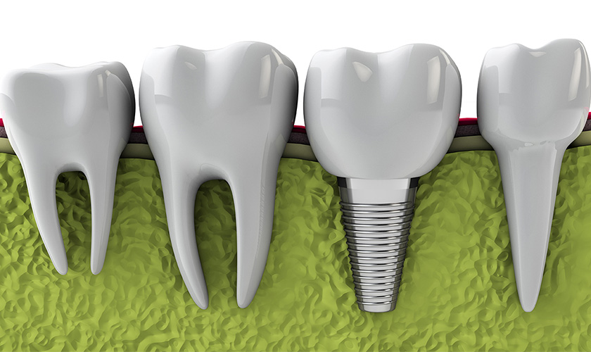 Bao Nhiêu Tuổi Trồng Răng Implant Được? - ảnh 2