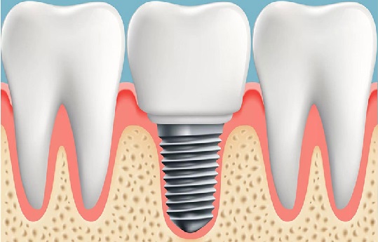 Bao Nhiêu Tuổi Trồng Răng Implant Được?