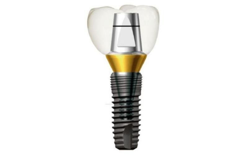 Giá Trụ Implant Mỹ - ảnh 7