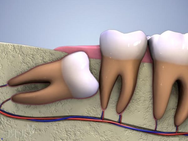 Nhổ Răng Khôn Hàm Dưới Có Khó Không? - ảnh 2