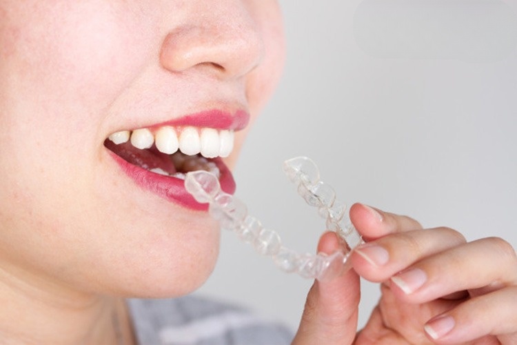 Niềng Răng Invisalign Có Đau Không? - ảnh 4