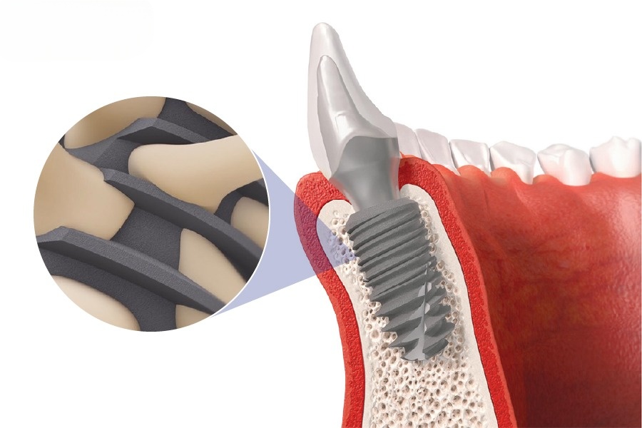 Trụ Implant Pháp Có Tốt Không? - ảnh 5