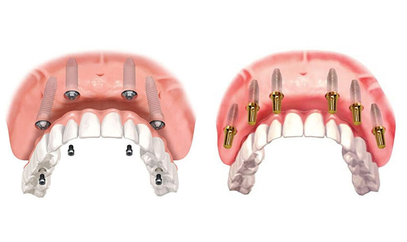 bảng giá trồng răng implant - ảnh 3
