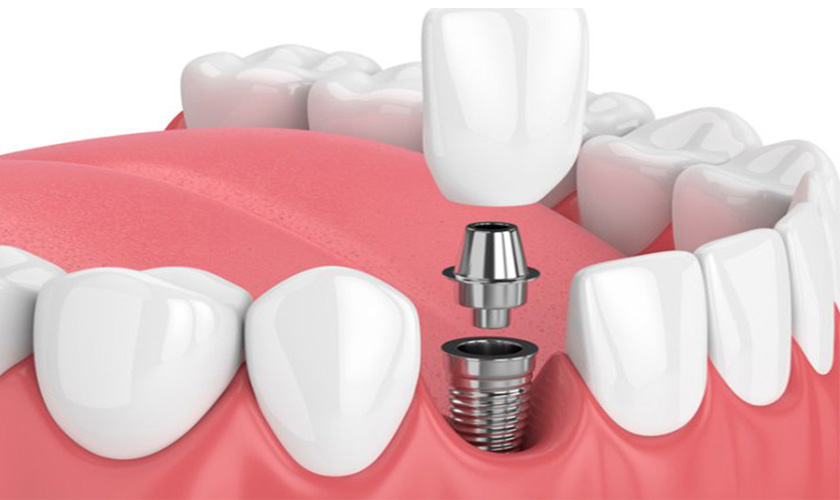 bảng giá trồng răng implant - ảnh 6