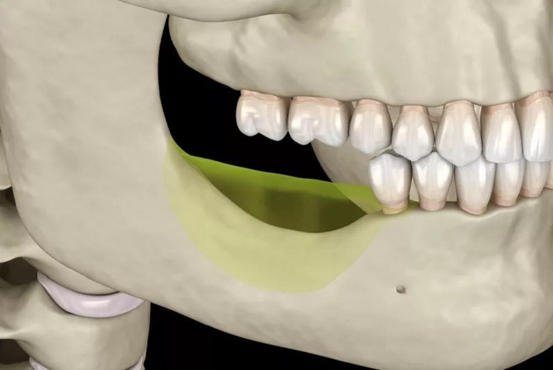 có nên trồng răng implant - ảnh 3