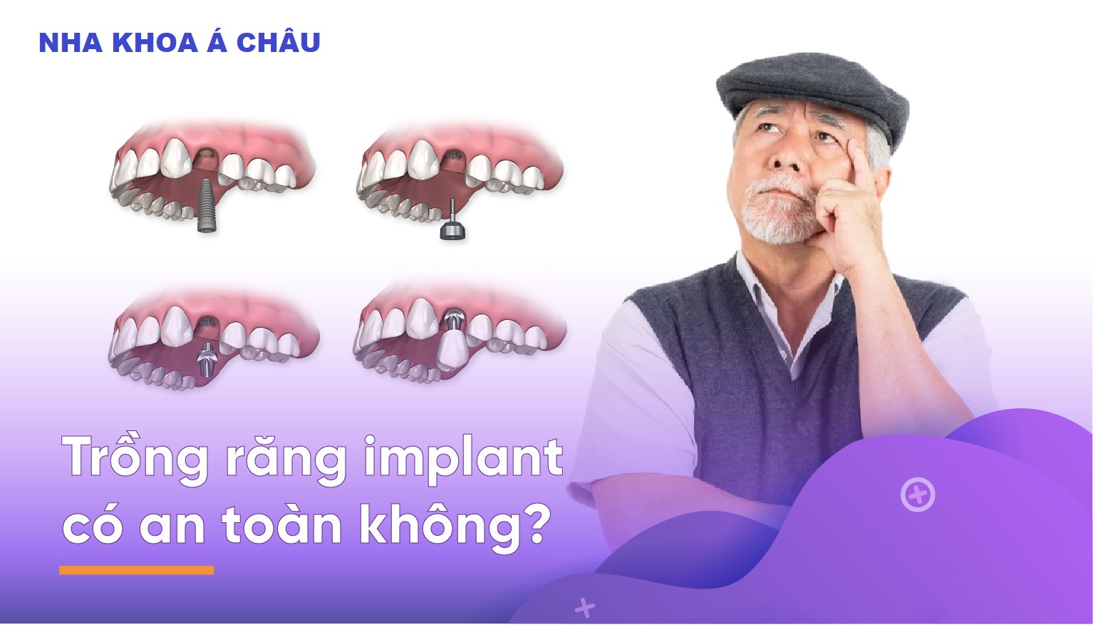 Trồng răng implant có ảnh hưởng đến sức khỏe không? Có an toàn không?