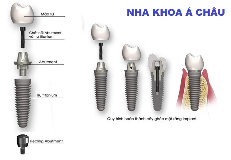 Cấu Tạo Trụ Implant? Cách chọn trụ Implant phù hợp ẢNH 1