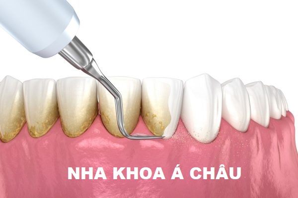 7+ Điều cần biết cho người chưa bao giờ lấy cao răng