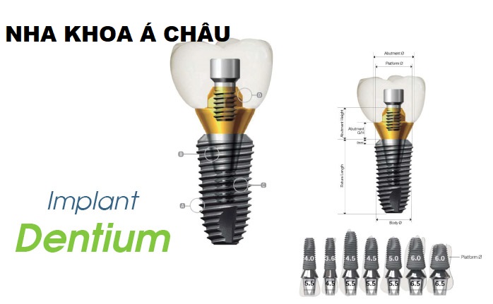 Cấu Tạo Trụ Implant? Cách chọn trụ Implant phù hợp