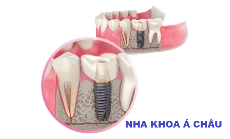 Trụ Implant DIO Hàn Quốc có tốt không?