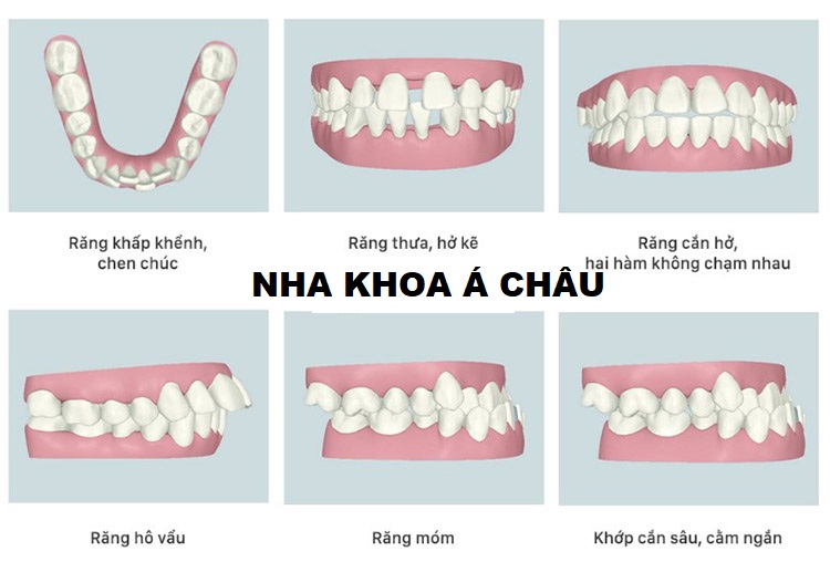 Bọc răng sứ có niềng được không?