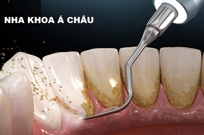 7+ Điều cần biết cho người chưa bao giờ lấy cao răng ẢNH 1