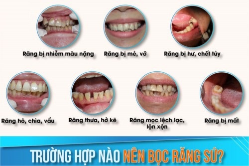 Bọc răng sứ có niềng được không?