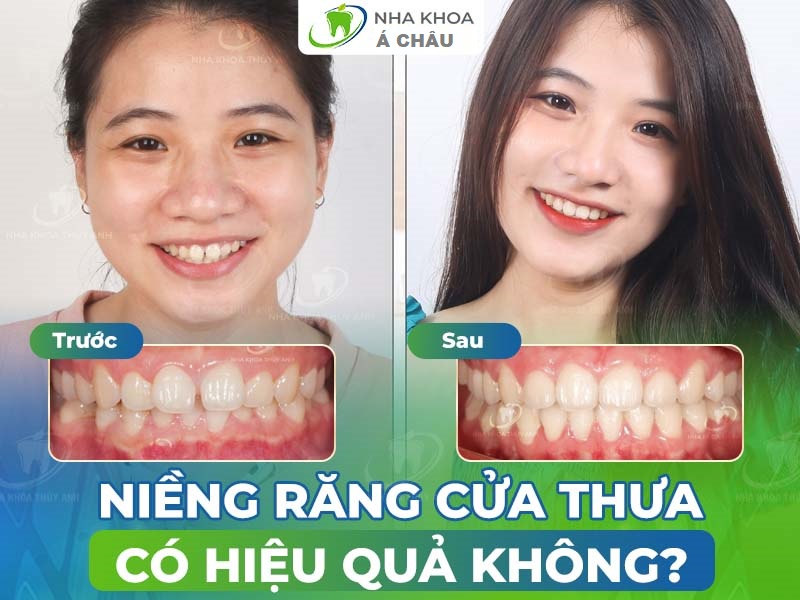 Tướng răng cửa thưa hé lộ gì về Vận mệnh Tình duyên?