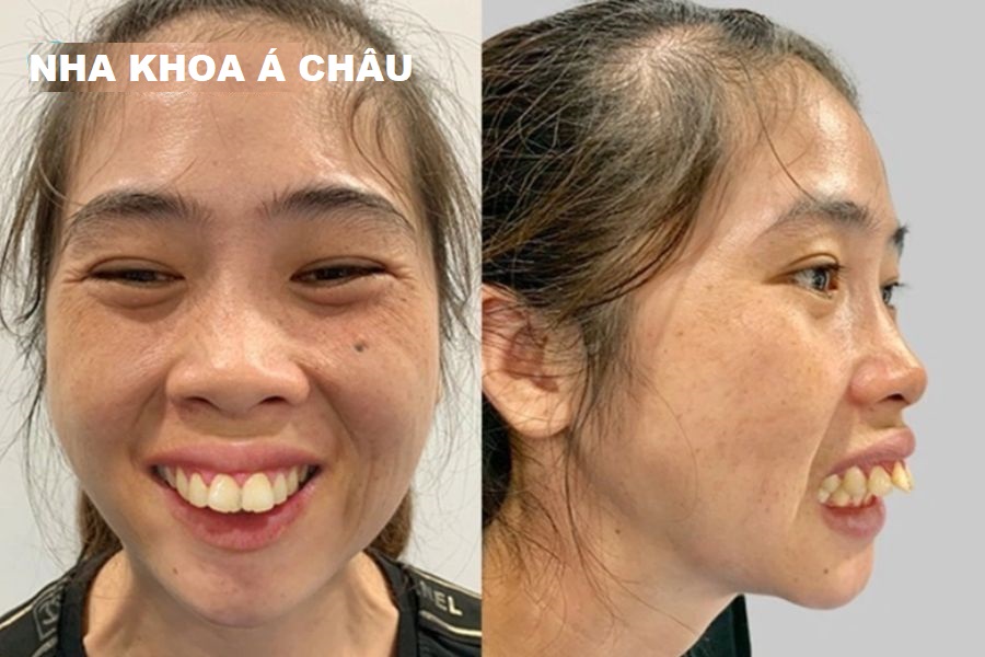 Xem tướng người răng hô chính xác nhất