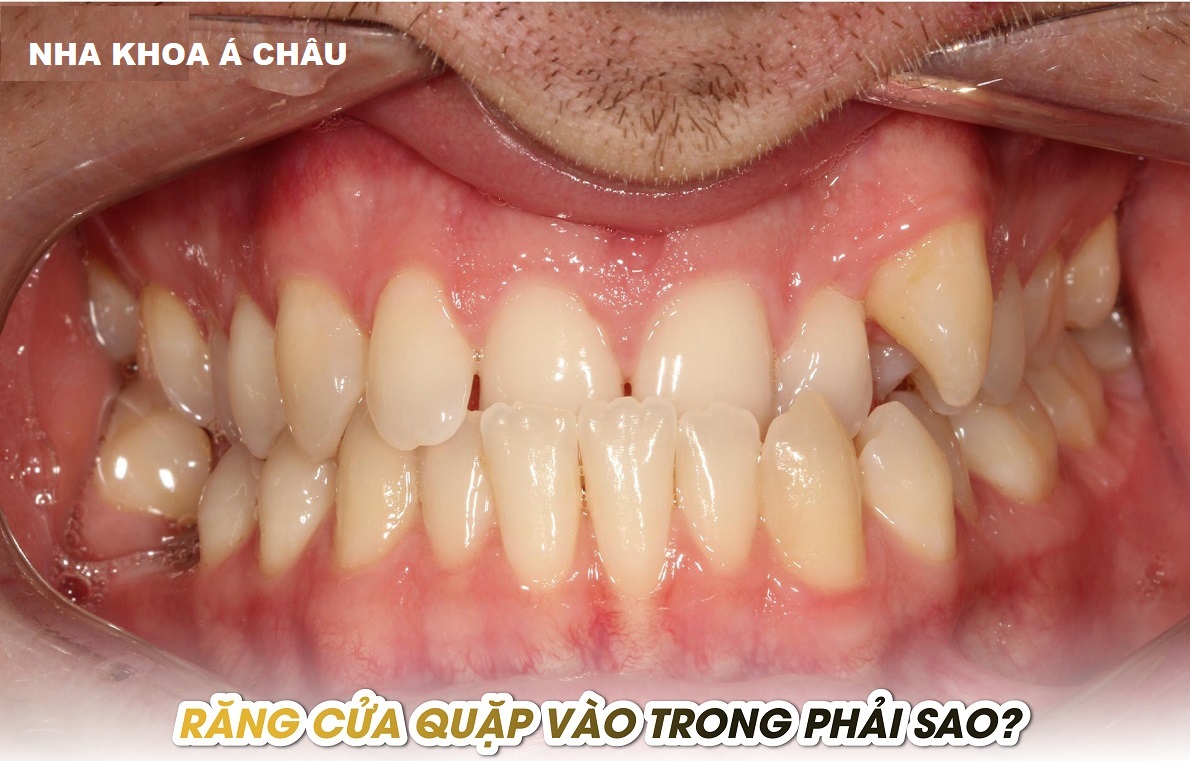 Răng cửa quặp vào trong có sao không? 1