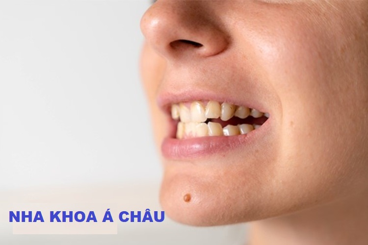 Răng cửa quặp vào trong có sao không? 6