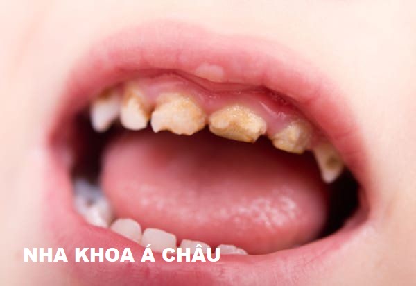 Nhổ răng sữa chưa lung lay có đau hay để lại biến chứng gì không? 2