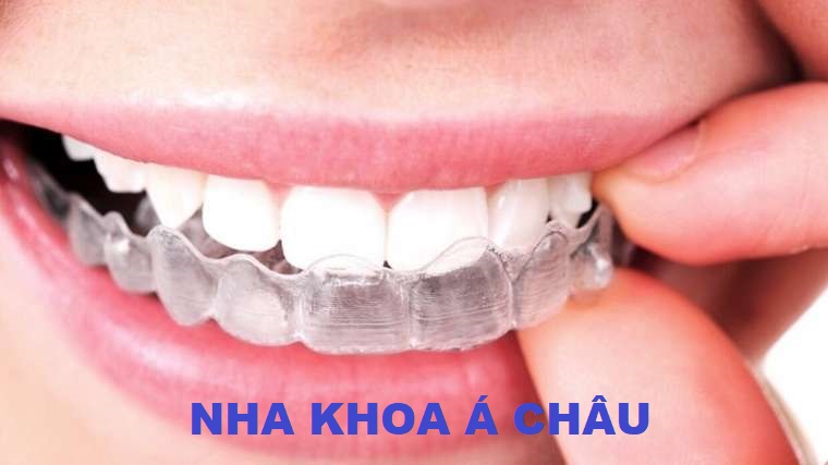 Kinh nghiệm tẩy trắng răng – Chia sẻ 6 phương pháp phổ biến 5