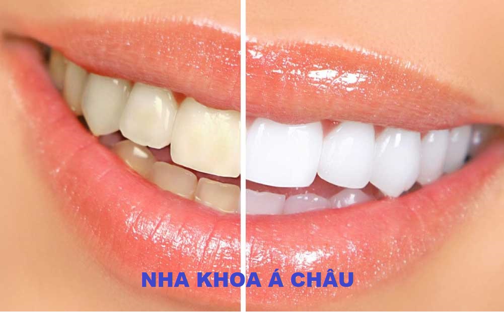 Kinh nghiệm tẩy trắng răng – Chia sẻ 6 phương pháp phổ biến 1