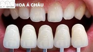 Tướng răng cửa thưa hé lộ gì về Vận mệnh Tình duyên?