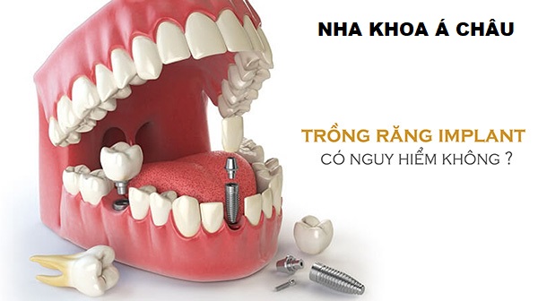 Trồng răng implant có ảnh hưởng đến sức khỏe không? Có an toàn không?