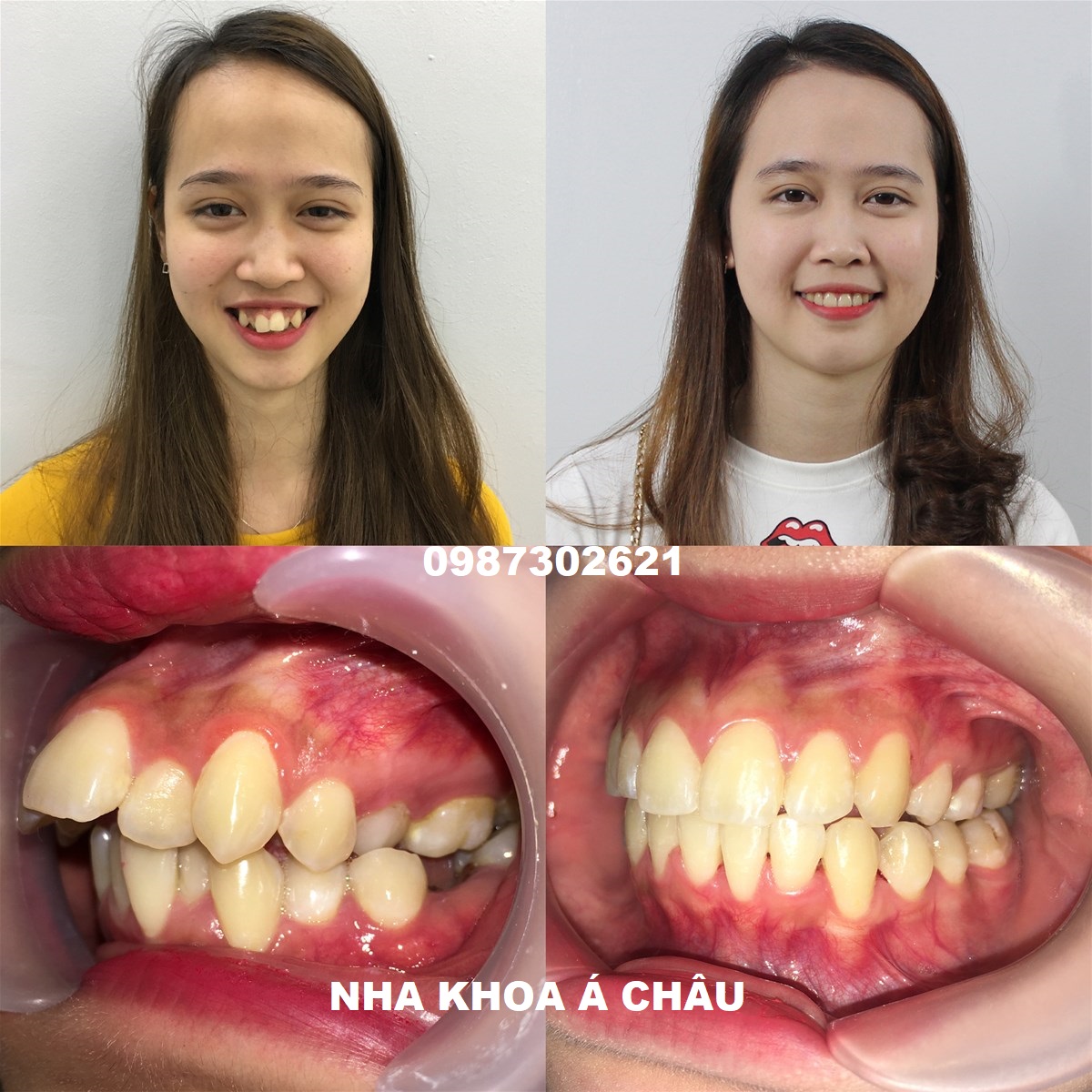 Xem tướng người răng hô chính xác nhất